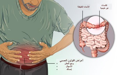 أعراض القولون الهضمي