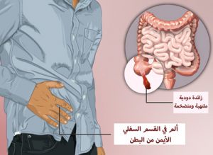 التهاب-الزائدة-الدودية-