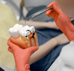 علاج-تسوس-الاسنان-في-العيادة