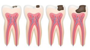 مراحل-تسوس-الاسنان